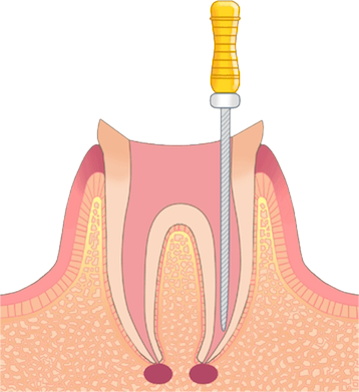 根管治療