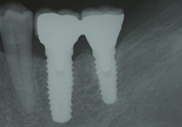 奥歯のインプラントのレントゲン