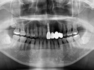 インプラント症例①