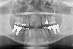 インプラント症例②